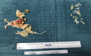 Surgical specimen of predominant webs.