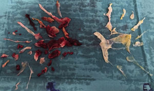 Surgical specimen from patient 3. Note the large quantity of clot casts and webs removed, which, together with the reduction in pulmonary artery pressure confirmed immediately after surgery, led us to expect a good outcome. However, the patient did not survive.