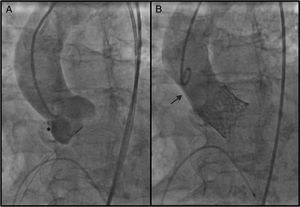 Aortography images: (A) after balloon valvuloplasty: * marks the probable starting point of the dissection; (B) after valve placement: subtraction image from the aortic root above the right coronary sinus to the mid ascending aorta.