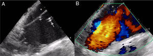 Intracardiac echocardiography images: (A) intimal flap dividing the aorta into a true lumen, in which the tip of the pigtail catheter can be seen (arrow), and a false lumen (*); (B) color Doppler with virtually no systolic antegrade flow in the false lumen.