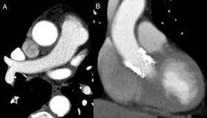 Control contrast thoracic computed tomography images: complete resolution of the dissection in both transversal (A) and coronal (B) planes.