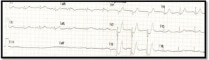 Initial electrocardiogram showing a De Winter pattern (3-6mm ST-segment depression with high symmetrical T waves in leads V2-V3).