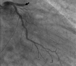 Angiography frame showing occlusion of the proximal left anterior descending coronary artery.
