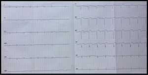 Follow-up electrocardiogram after angioplasty, showing QS without T waves in leads V1-V4.