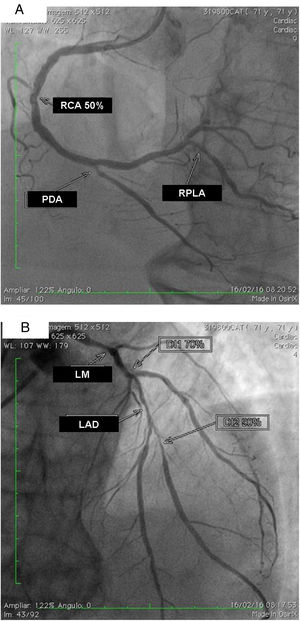 (A) Right coronary artery (RCA) with important calcification and 50% lesion in the mid third, posterior descending artery (PDA) and right posterolateral artery (RPLA) with severe calcification and lesions of 80% and 70%; respectively; (B) left main (LM) with calcified lesions of 80% in the distal third, left anterior descending artery (LAD) with significant calcification and 90% in the mid third, and diagonal branches (DG1 and DG2) with calcified lesions of 70 and 80%, respectively. The left circumflex is occluded and calcified.