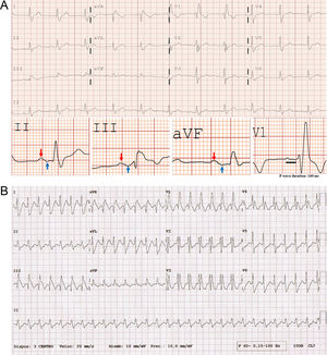 Bayés syndrome | Revista Portuguesa de Cardiologia