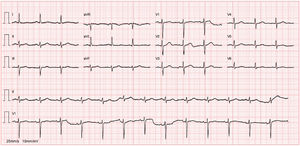 Baseline electrocardiogram performed during cardiology follow-up consultation: sinus rhythm, without pathological Q waves or major ST-T changes.