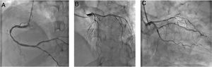 Emergent coronary angiography. (A) Right coronary artery with moderate disease in mid segment and mild disease in distal segment; (B and C) left main coronary artery with no significant lesions; left anterior descending artery with diffuse disease; left circumflex artery with mild disease and stent in mid segment without restenosis.
