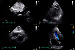 Echocardiogram showing the lead crossing the inferior vena cava and right atrium (A), and its anomalous course across the muscular portion of the intraventricular septum, with the tip in the left ventricle (B and C). No shunt was detected between the right and left ventricles (D).