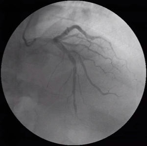 Coronary angiography with slow flow and non-obstructive disease.