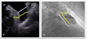 Transesophageal echocardiogram (A) and fluoroscopy (B) images showing the diameter of the left atrial appendage at the landing zone (yellow lines) 10 mm inside the left atrial appendage orifice (gray lines).