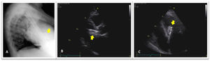 Lateral chest X-ray view (A) and two-dimensional transthoracic echocardiogram parasternal long-axis (B) and apical four-chamber (C) views revealing embolized device in the left ventricle outflow tract (arrows).