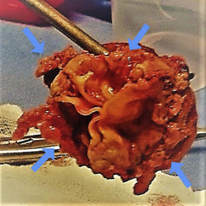 Surgical specimen of the mitral valve prosthesis (left ventricular face). Arrows show friable vegetations adhering to the three valve leaflets.