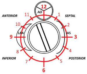 Classification of paravalvular leaks according to reference points (12 o’clock: mitral-aortic curtain). IAS: interatrial septum; LAA: left atrial appendage.