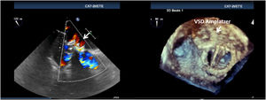 Microjets in a ventricular septal defect Amplatzer plug after successful closure of a very large round leak, a possible cause of unexpected hemolysis.