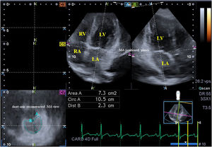 Images from the three-dimensional full-volume dataset showing the mitral annulus in a patient with acromegaly including apical 4-chamber (A) and 4-chamber (B) long-axis views and a cross-sectional view at the level of the mitral annulus (C7) optimized in long-axis views. Area: mitral annular area; Circ: mitral annular perimeter; Dist: mitral annular diameter; LA: left atrium, LV: left ventricle, RA: right atrium, RV: right ventricle.