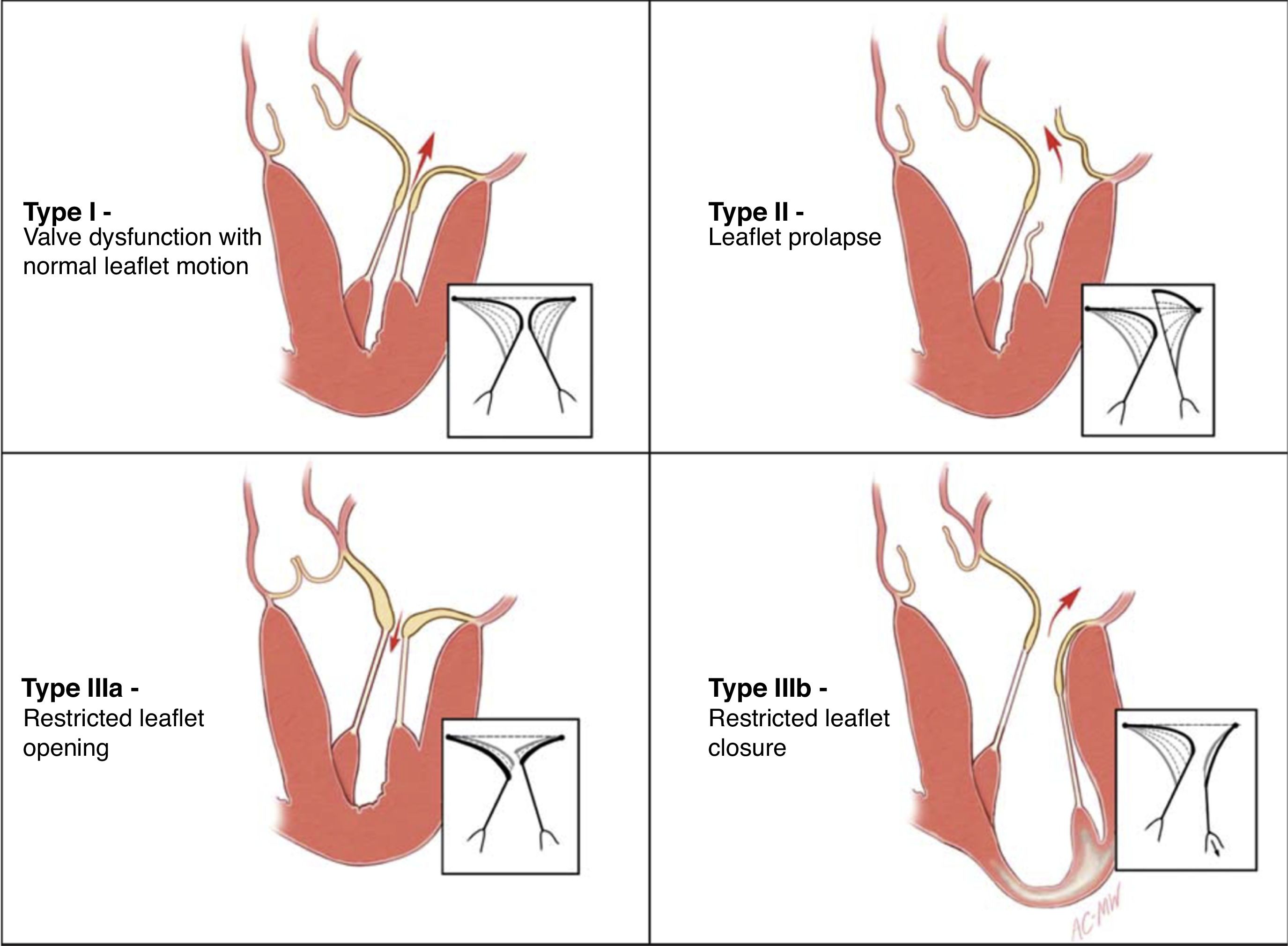 posterior mv leaflet prolapse