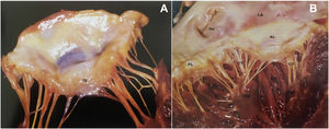 (A) The greater thickness of the rough zone (rz) of the anterior mitral valve leaflet; (B) posterior view of the open mitral valve, between the left atrium (LA) and the left ventricle (LV) (from 13). Ap: left atrial appendage; AL: anterior leaflet; CT: chordae tendineae; PL: posterior leaflet; PM: papillary muscle.