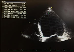 Left ventricular ejection fraction estimated at 26% by Simpson’s single-plane method in apical 4-chamber view (image from a GE Vivid I portable ultrasound machine).