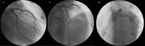 Diagnostic cardiac catheterization showing no coronary lesions. Left to right: right caudal view of the left coronary artery; left cranial view of the left coronary artery; left cranial view of the right coronary artery.