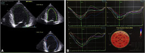 Second transthoracic echocardiogram (images from a GE Vivid 9). (A) Left ventricular ejection fraction estimated semi-automatically in apical 4-chamber view at 46%; (B) global longitudinal strain estimated at −16.7%.