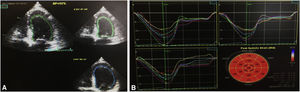 Transthoracic echocardiogram after hospital discharge (images from a GE Vivid 9). (A) Left ventricular ejection fraction estimated semi-automatically in apical 4-chamber view at 52%; (B) global longitudinal strain estimated at −20.2%.