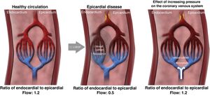 Mechanism of action of coronary sinus reduction (from Ref. 46). LVEDP: left ventricular end-diastolic pressure.