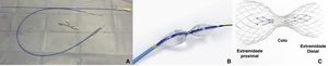 Delivery sheath, balloon catheter and coronary sinus reducer device. (A) The device pre-mounted in the delivery system; (B) inflated balloon; (C) device in its final conformation after balloon inflation and removal.