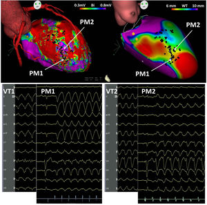 Top left: voltage map of the left ventricle in right anterior oblique view, showing a large zone of scar in the anterior and septal regions, harboring local abnormal ventricular activations (black dots); top right: cardiac computed tomography images processed with ADAS-VT software (Galgo Medical, Barcelona, Spain) showing two large zones of septal and anteroapical wall thinning (<6 mm, red), separated by a very small zone of thicker wall (yellow, 6-10 mm). The morphology of the 12-lead electrocardiogram of VT1, VT2, and PM1 and PM2 is shown in the bottom traces. PM: pace-mapping; VT: ventricular tachycardia.