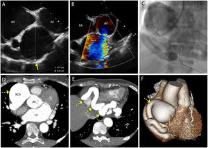 (A) Transesophageal echocardiogram shows a large aneurysmal structure (yellow arrow) adjacent to the right atrium and aorta valve (measuring 47 mm in diameter with (B) turbulent flow on color flow doppler. (C) Coronary angiography demonstrates a large right coronary artery aneurysm proximally and a grossly ectatic vessel. (D-E) Computed tomography coronary angiography confirms a large proximal right coronary artery aneurysm (yellow interrupted arrow) with the remainder of the vessels ectatic and with a tortuous course (yellow interrupted arrow). (F) Computed tomography coronary angiography 3D reconstruction of right coronary artery aneurysm (yellow interrupted arrow).