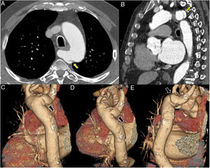 Computed tomography angiography of the aorta, axial view (A), multiplanar reformatting in sagittal view (B), and volume rendering in oblique posterior views (C-E). Focal bulging of 21 mm×8 mm with a ‘mushroom cap’ appearance at a Kommerell diverticulum of the aberrant right subclavian artery (yellow arrows in A and B, black arrows in C-E). The latter compresses the esophagus posteriorly along its course to the right and passes 8 mm posterior to the right posterolateral margin of the trachea. The aortic size is within normal range and no other structural abnormalities of the aorta are observed. Note that vascular repair at this location may entail technical difficulties, particularly anchoring the endoprosthesis at the origin of the right subclavian artery. In addition, total exclusion of the dissected segment cannot always be achieved.