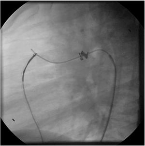 Lateral projection depicting guidewire capture with a Snare catheter in a patient with a previously implanted coil and residual significant shunt (arteriovenous loop).