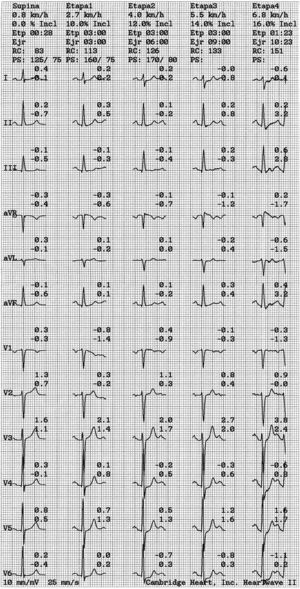 Rest and exercise electrocardiogram recording during Bruce protocol treadmill test. From left to right: rest, stage 1, stage 2, stage 3 and stage 4 (maximum effort).