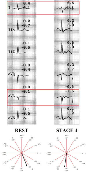 Exercise-induced left fascicular block: A forgotten sign of coronary ...