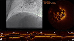 Optical coherence tomography. Intravascular imaging technique demonstrating the presence of fibrotic webs inside the vessel.