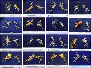 Specimens of pulmonary thromboendarterectomy specimens.