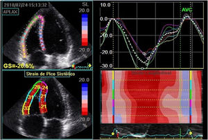 Global right ventricular longitudinal strain, obtained by averaging the strain of the three segments of the right ventricular free wall in a patient with type 1 diabetes. In this case, it was estimated at -30.6%. Note: The value shown in the figure considered the septal wall segments for strain calculation. GLPS_Avg: mean global longitudinal peak systolic strain; AVC: aortic valve closure time; HR: heart rate; AFI: automated imaging function.