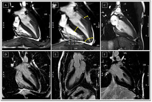 Cardiac magnetic resonance before detraining. (A-C) Cine steady state free precession sequences (in diastole) with overlapping echocardiographic findings – similar wall thicknesses, particularly in the LV apical segments. Long-axis horizontal views enable visualization of the apex, with a clearly abnormal cavity morphology, confirming the diagnosis of apical hypertrophic cardiomyopathy, mixed form, with an ‘ace of spades’ configuration; (D-F) delayed enhancement sequences showing absence of myocardial fibrosis. LA: left atrium; LV: left ventricle; RA: right atrium; RV: right ventricle.