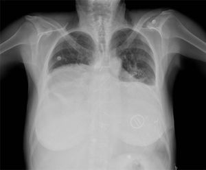 Chest X-ray with giant cardiac silhouette, sternal suture and mechanical mitral valve.