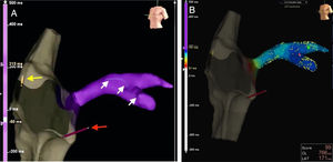 (A) Real-time visualization of catheter location (red arrow pointing to right ventricular lead, and yellow arrow to right atrial lead) and the VisionWire (Biotronik) inside the coronary sinus branches (white arrows); (B): electrical activation mapping of coronary sinus branches with guidewire and identification of the latest ventricular activation (mid segment of the lateral branch, dark blue).