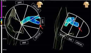 Coronary sinus activation mapping and final position of the left ventricular lead (red arrow).