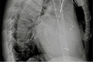 Chest X-ray (left lateral view) with lead position 24 hours after implantation.