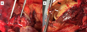 External (A) and internal (B) aorta view. Rupture point (asterisk), saphenous anastomosis (white arrow) and aortic calcification (black arrow).