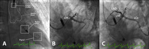 Example of high-risk percutaneous coronary intervention (PCI) supported with an Impella® CP in a patient with multivessel disease presenting with acute myocardial infarction, severe left ventricular (LV) dysfunction and shock. (A) Impella® CP device placed in the LV cavity and ascending aorta; the main radiographic components are depicted; (B) coronary angiogram showing occlusion of the proximal left anterior descending (LAD) and mid-left circumflex (LCx) coronary arteries; (C) coronary angiogram following PCI of the LAD and LCx. LM: left main coronary artery.
