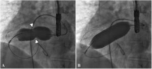 Balloon dilation of a restrictive atrial septal defect (ASD). (A) A waist on the balloon at the site of the restrictive ASD (arrowheads); (B) the waist was completely abolished after full inflation of the balloon.