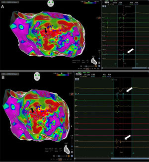 Example of fragmented potentials (A) and late potentials (B) (white arrows) identified during sinus rhythm, using a high-density mapping catheter (black arrows) in an ischemic cardiomyopathy patient.