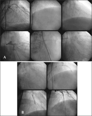 – Chronic total occlusion of the left anterior descending artery. In A, the guide is inserted through the ipsilateral septal channel, and is positioned in the contralateral guide catheter. Then, the guide was replaced by a 3-m guide, which was removed through a collateral introducer using a snare guide to guarantee good support. In B, with an appropriate support, a 1.25-mm balloon is passed contralaterally, followed by a stent implant.