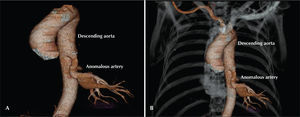 – Chest computed angiotomography. In A and B, the presence of an anomalous artery emerging from the descending aorta into the direction of the left lower lung lobe.