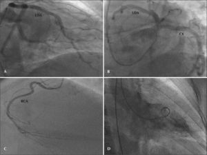 – Coronary angiography. In A and B, anterior descending and circumflex arteries without significant obstructive lesions. In C, right coronary artery without significant obstructive lesions. In D, left ventriculography indicating preserved ventricular function. RCA=right coronary artery; CX=circumflex artery; LAD=left anterior descending artery.