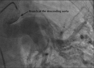– Selective characterisation and opacification of the anomalous vessel originating from the descending thoracic aorta.